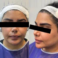 کاشت ابرو زیر بیست میلیون|خدمات آرایشگری و زیبایی|گرگان, |دیوار