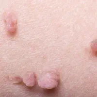 سوزاندن خال گوشتی و منگوله