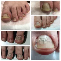 درمان ناخن فرورفته درگوشت .ارتونیل وپدیکور درمانی