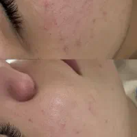 پاکسازی و فیشیال تخصصی پوست