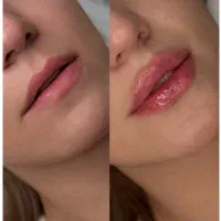 ژل بوتاکس مزوتراپی جوانساز فشیال پاکسازی|خدمات آرایشگری و زیبایی|اندیشه, اندیشه فاز ۱|دیوار