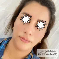 ژل وبوتاکس بلک فرایدی404(اقساط)(توسط پزشک)|خدمات آرایشگری و زیبایی|خرمآباد, |دیوار