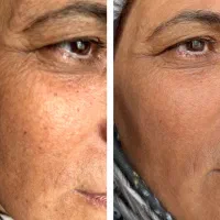 تخفیف ویژه پی آر پی|آرایشی، بهداشتی، درمانی|بهبهان, |دیوار