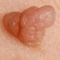زخم دیابت.   زگیل تناسلی   بدون عمل و بستری