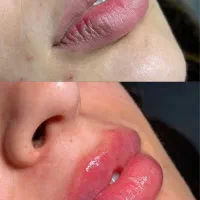 آف ژل و بوتاکس از ۱۲۰۰به ۱میلیون