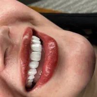 دندانپزشکی/کامپوزیت/لمینیت/یک فک رایگان