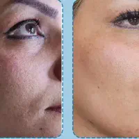 پی آر پی مو و صورت 800