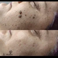 لیفت و جوانسازی پلک بدون جراحی با تخفیف ۵۰ درصد|خدمات آرایشگری و زیبایی|اصفهان, مرداویج|دیوار