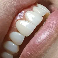 کامپوزیت ونیر دندان ها با تکنیک لیرینگ