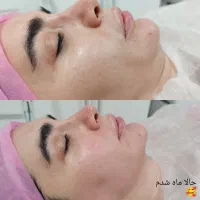 پاکسازی آبرسانی و فیشال پوست صورت|خدمات آرایشگری و زیبایی|تهران, حکیمیه|دیوار