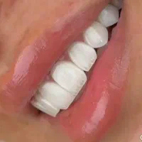 بلیچینگ ارتودنسی ایمپلنت کامپوزیت لمینت(اقساطی)|خدمات آرایشگری و زیبایی|سیرجان, |دیوار