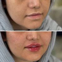 معماری صورت با فیلر/بوتاکس/پی ارپی/سلول های بنیادی|خدمات آرایشگری و زیبایی|تبریز, |دیوار