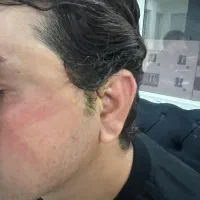 لیفت شقیقه ،بلفارو ،غبغب وغیره|خدمات آرایشگری و زیبایی|اهواز, کیانپارس |دیوار
