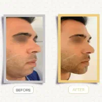 ساکشن غبغب|خدمات آرایشگری و زیبایی|رشت, گلسار|دیوار