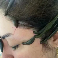 حجامت کبد فصد خون زالو درمانی واریس مزاج شناسی