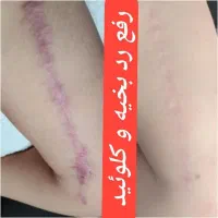 جشنواره ترمیم انواع اسکاروجای جوش/تا ۵ دی