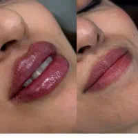 آفر ژل لب تکنیکM گونه چانه زاویه سازی کانتورینگ