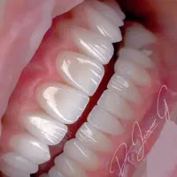 دندانسازی لبخند متحرک ثابت از دست کامل ۸ به بالا