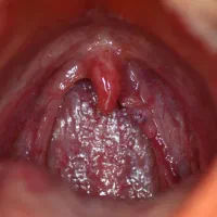 بهبود اچ پی وی|آرایشی، بهداشتی، درمانی|آزادشهر, |دیوار