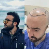 کاشت مو تیم شیراز و مشهد در یزد (تضمینی و اقساطی)|خدمات آرایشگری و زیبایی|یزد, |دیوار