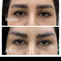 بلفاروپلاستی لیفت صورت بوکال فت تزریق چربی|خدمات آرایشگری و زیبایی|کرمانشاه, |دیوار