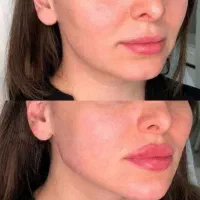 آموزش ژلو بوتاکس