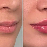 تخفیف تزریق فیلر و بوتاکس