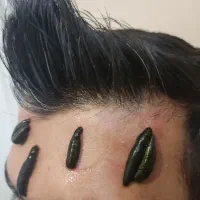 تخفیف۵۰٪ حجامت، فصد پیشانی، زالو، غلظت واریس دیسک