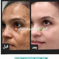 کرم ضدلک و روشن کننده درخشان(بدون بازگشت)|حراج|مشهد, بهشت|دیوار