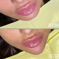 مطب پزشک ژل لب گونه چونه زاویه فک بوتاکس فیلر بینی|خدمات آرایشگری و زیبایی|قم, صفائیه|دیوار