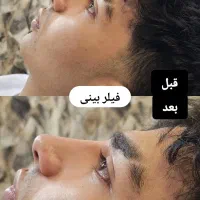 بوتاکس و ژل(فیلر)،بدون درد با ماندگاری بالا