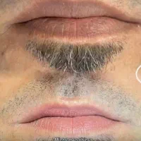 میکروبلیدینگ ورفع کبودی لب وبن مژه اقایان وخانمها