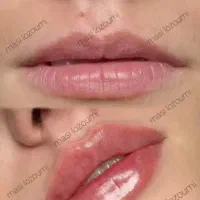 مرکز تخصصی ژل و بوتاکس در قزوین|خدمات آرایشگری و زیبایی|قزوین, |دیوار