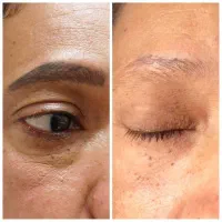 لیزر کیوسوئیچ برای پوستی شفاف و جوان