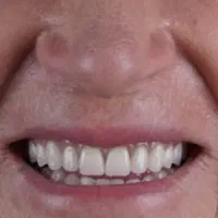 دندانسازی دندان مصنوعی