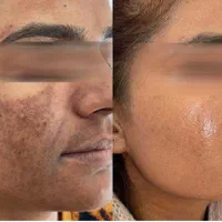 لیزر پاک تاتو کک و مک ماه گرفتگی ترک بارداری|خدمات آرایشگری و زیبایی|مشهد, سرافرازان|دیوار