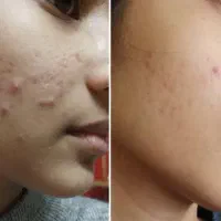 درمان جوش صورت و بدن|خدمات آرایشگری و زیبایی|دوگنبدان, |دیوار