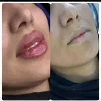 تخصص حرفه ای تزریق لب روسی|خدمات آرایشگری و زیبایی|ارومیه, |دیوار