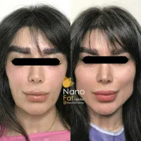 تزریق چربی صورت ماندگاری دائمی روی دست بیکینی باسن|خدمات آرایشگری و زیبایی|تهران, صادقیه|دیوار
