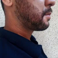 کاشت تخصصی ریش با جدید ترین متد و دستگاه پیشرفته