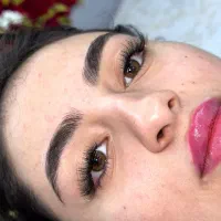 کاشت مژه هیدن یک ماهه