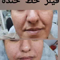 جشنواره ژل و بوتاکس و مزوتراپی لک وجوانسازی بانوان|خدمات آرایشگری و زیبایی|اصفهان, عسگریه|دیوار