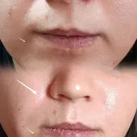 تزریق ژل فیلر بوتاکس مزوژل مزوتراپی مزو مو|خدمات آرایشگری و زیبایی|فولادشهر, C4|دیوار