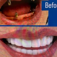 ایمپلنت ارتودنسی لمینت کامپوزیت|خدمات آرایشگری و زیبایی|مشهد, دوست آباد|دیوار