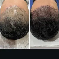 طرح تخفیف ژل و بوتاکس،مزوتراپی،نخ امبدینگ لاغری