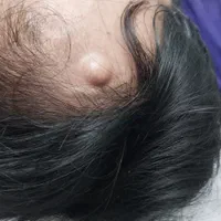 جراحی خال زگیل و میخچه و ناخن با لیزر در مطب پزشک