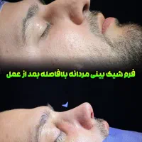 عمل جراحی بینی 35میلیون تومن درتهران