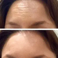 آموزش ژل بوتاکس آنزیم بوتاکس ۸۰۰ ژل600انزیم300