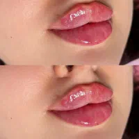 فیلر لب و صورت، بوتاکس و جوانسازی