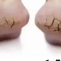 پوستی بدون ترک وپوسته پوسته شدن